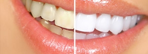 Tooth Whitening